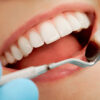 Come ottenere denti bianchissimi