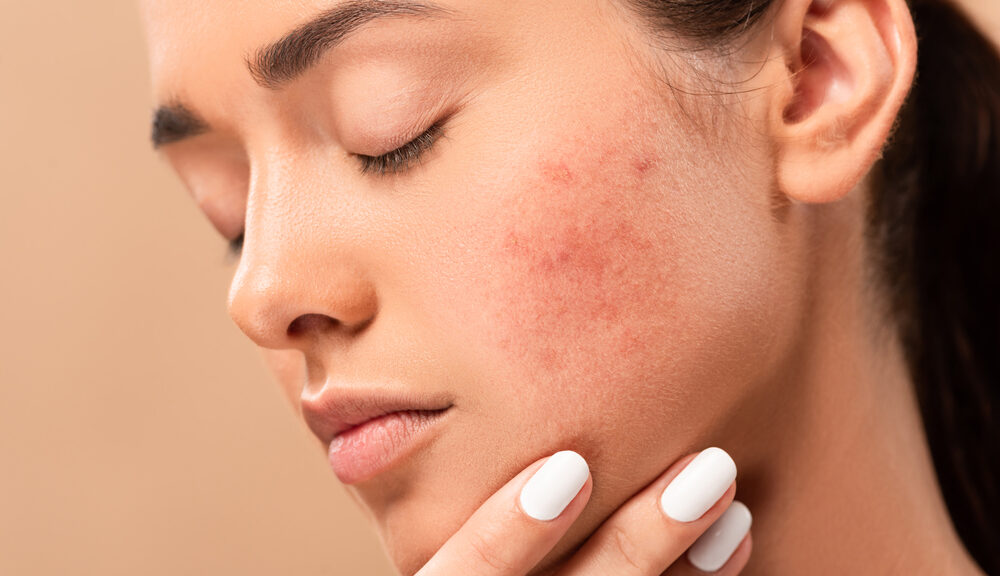 Acne e alimentazione: un approccio naturale per combattere l'infiammazione della pelle