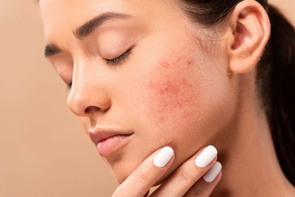 Acne e alimentazione: un approccio naturale per combattere l'infiammazione della pelle